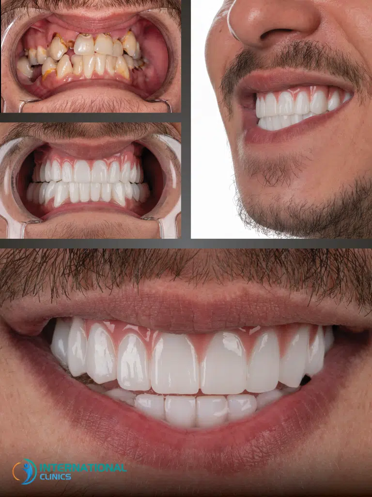 Cosmetic Dentistry Before and Afters