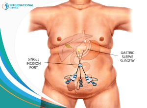 Single Incision Gastric Sleeve