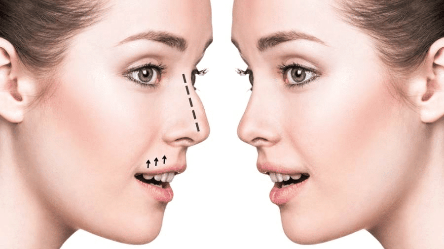 بوتكس الأنف قبل وبعد