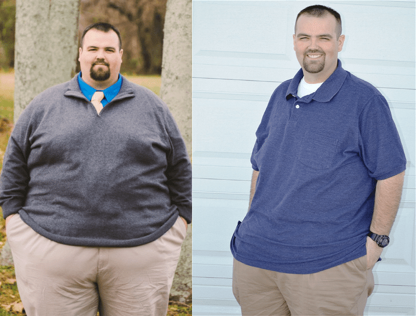 Gastric Sleeve vs Gastric Bypass before and after