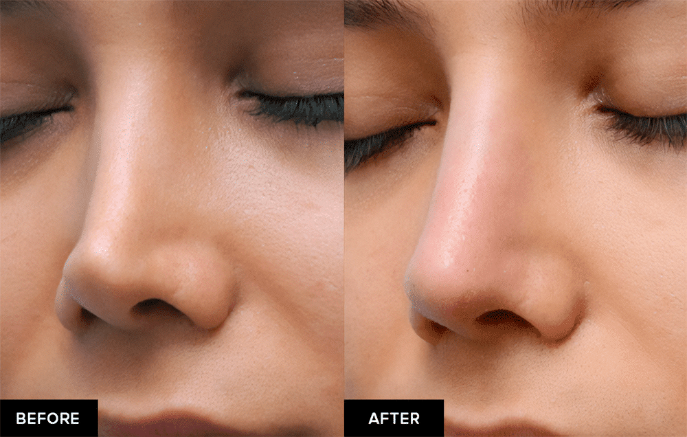 Fillers for Nose Before and After