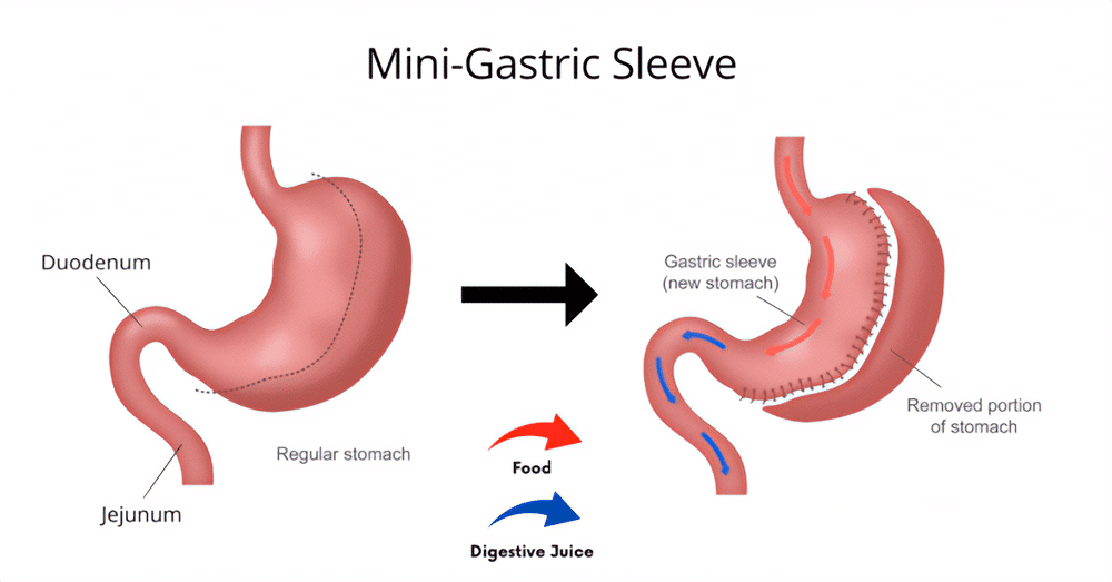 Mini Gastric Sleeve infographic