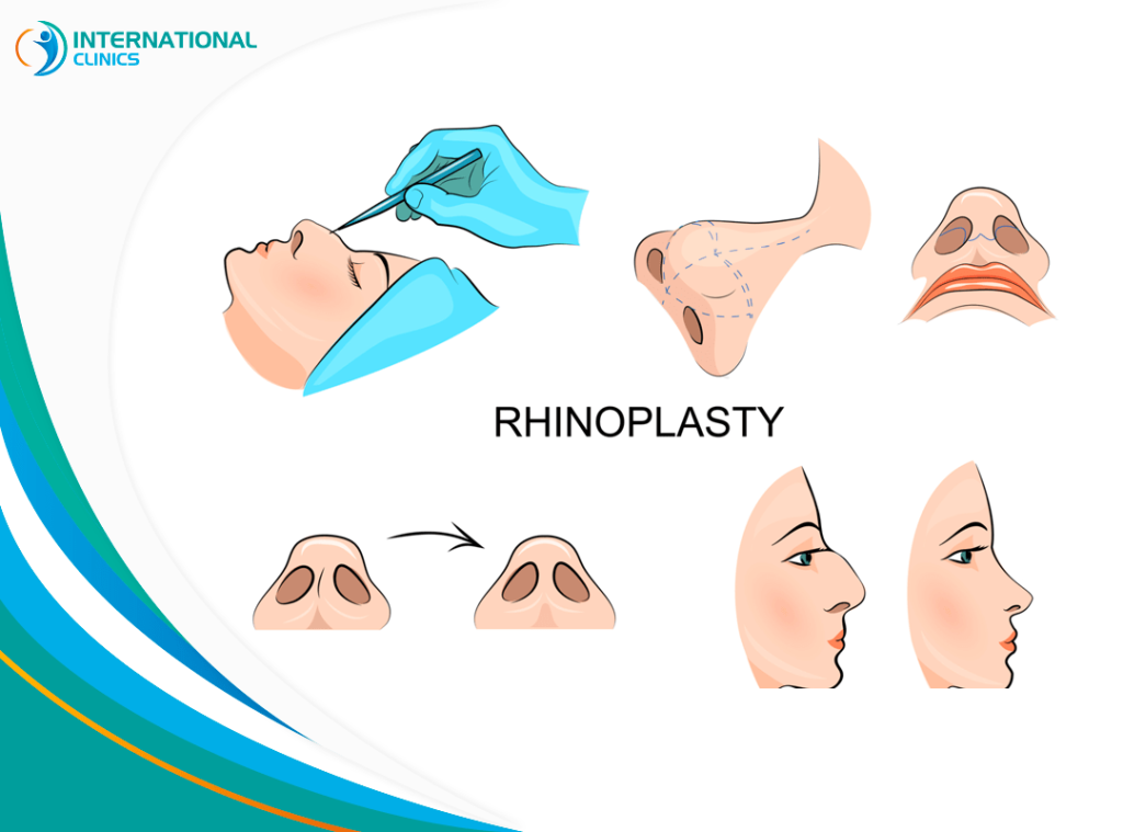 Types Of Rhinoplasty: A Comprehensive Guide 2023 - International Clinics