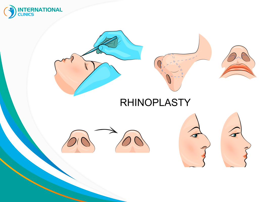 Types of Rhinoplasty