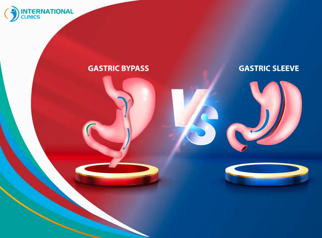 Gastric Sleeve vs Gastric Bypass