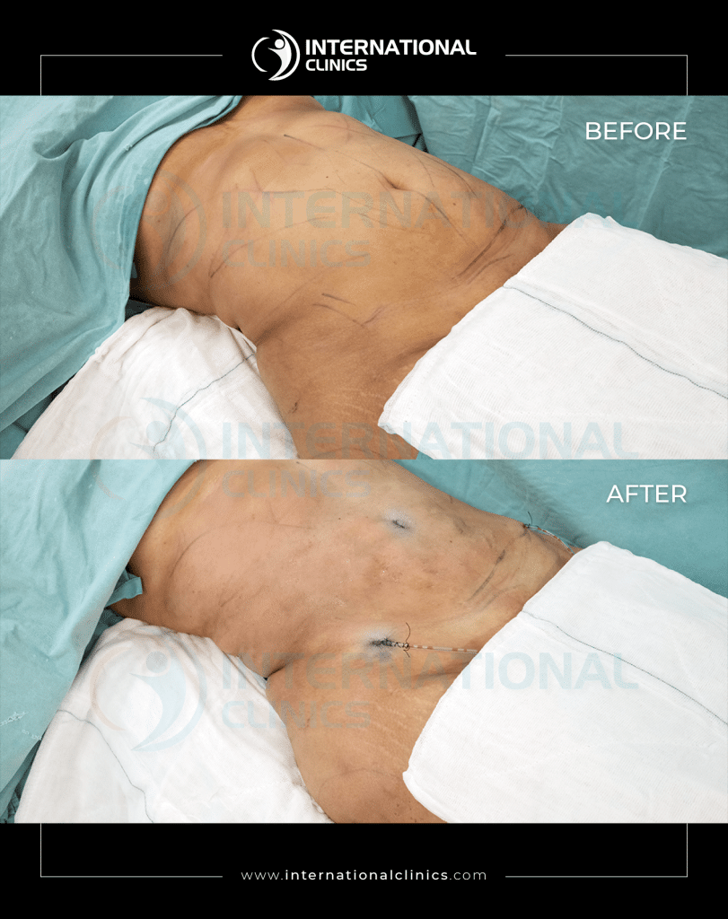 chirurgie esthétique du ventre photos