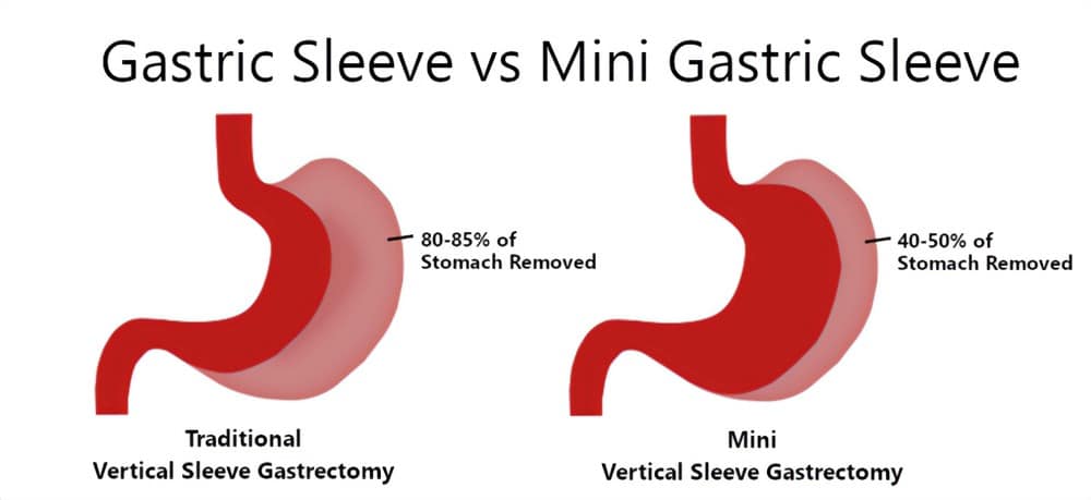 Mini Gastric Sleeve vs. Traditional Gastric Sleeve infographic