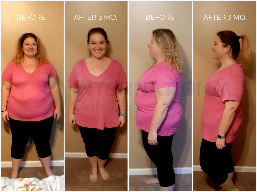 Gastric Sleeve Before and After 3 Months picture