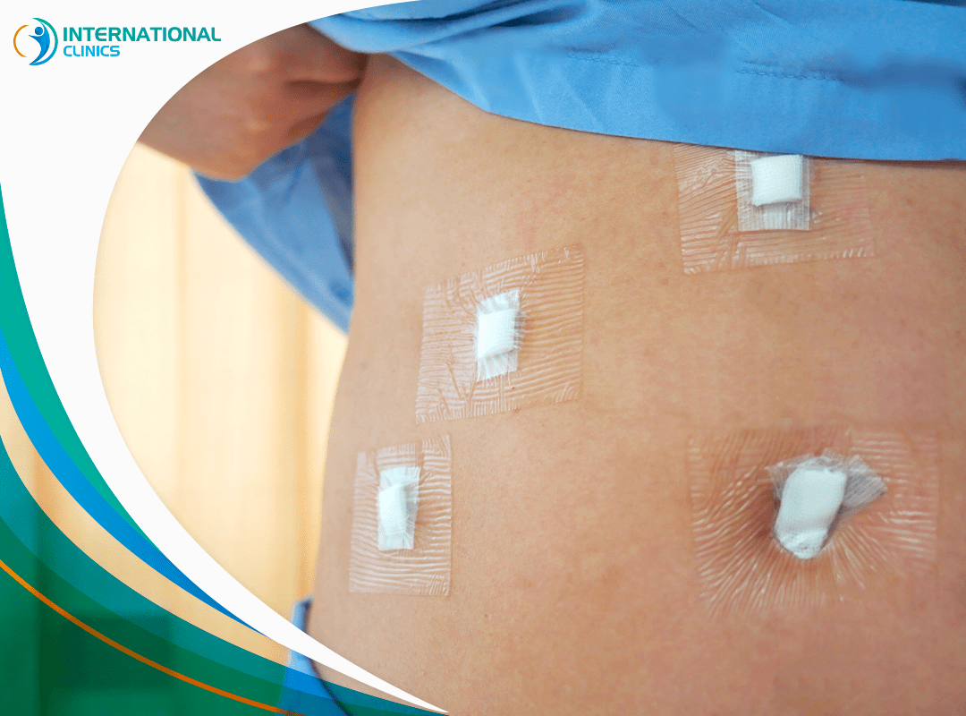 Gastric Sleeve Incisions