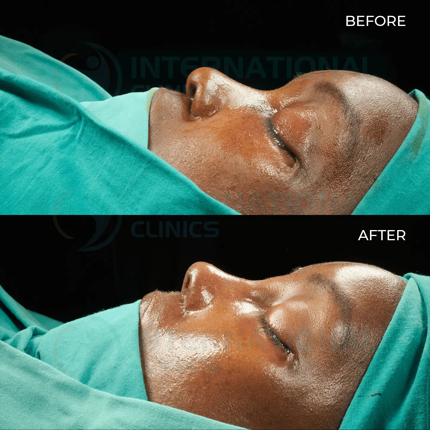 Ethnic Rhinoplasty Before and After image