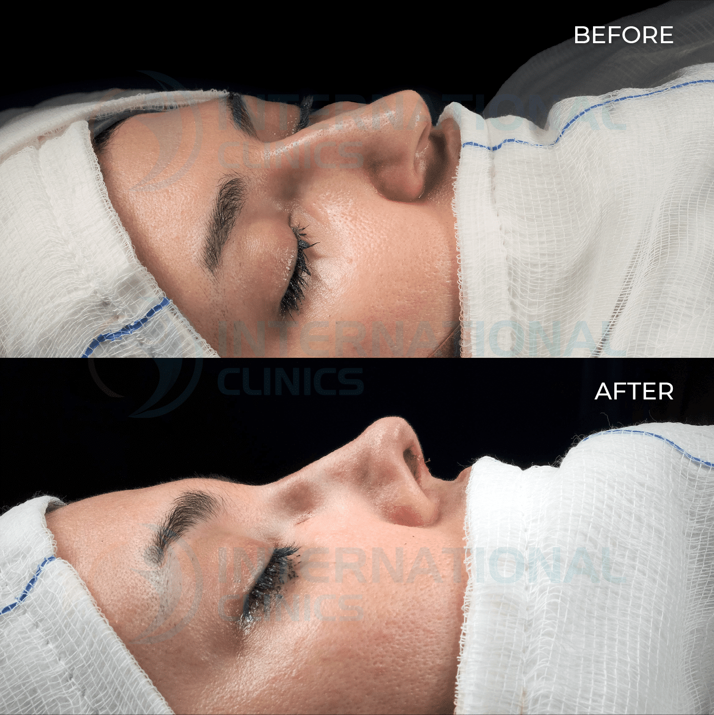 Ultrasonic Rhinoplasty Before and After picture