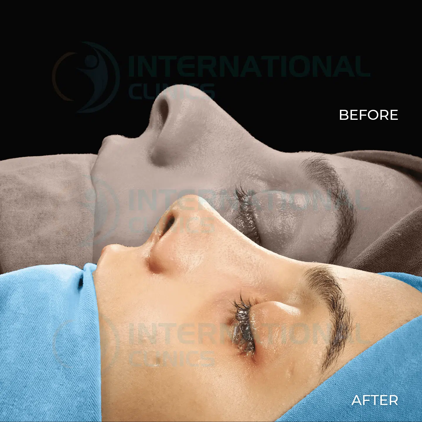 Ethnic nose job Before and After image