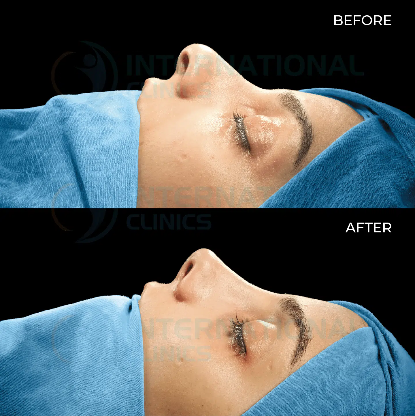 Asian Nose Job Before and After image