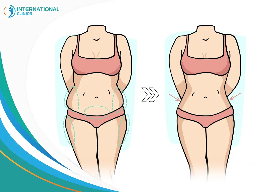What to Expect 3 Weeks After Liposuction?