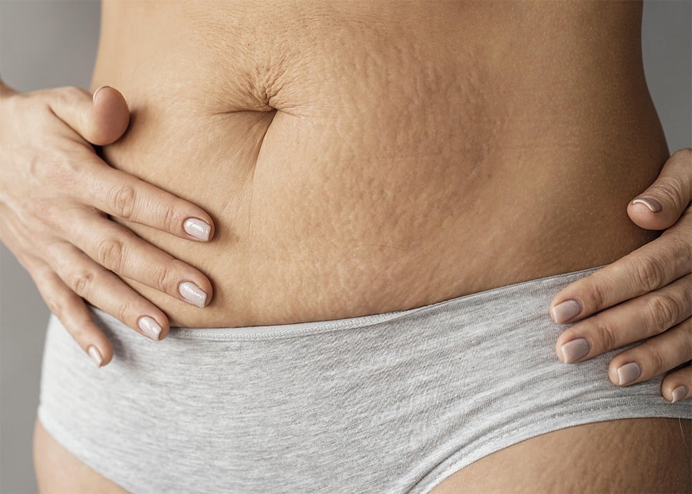 How to smooth out stomach after liposuction