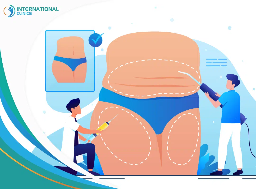 How Much Weight Can You Lose with Liposuction? Amount & Methods