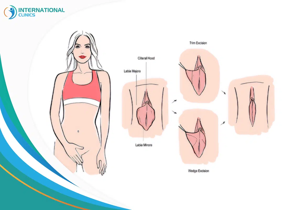 Before & After Labiaplasty Recovery Timeline: Tips & Stages