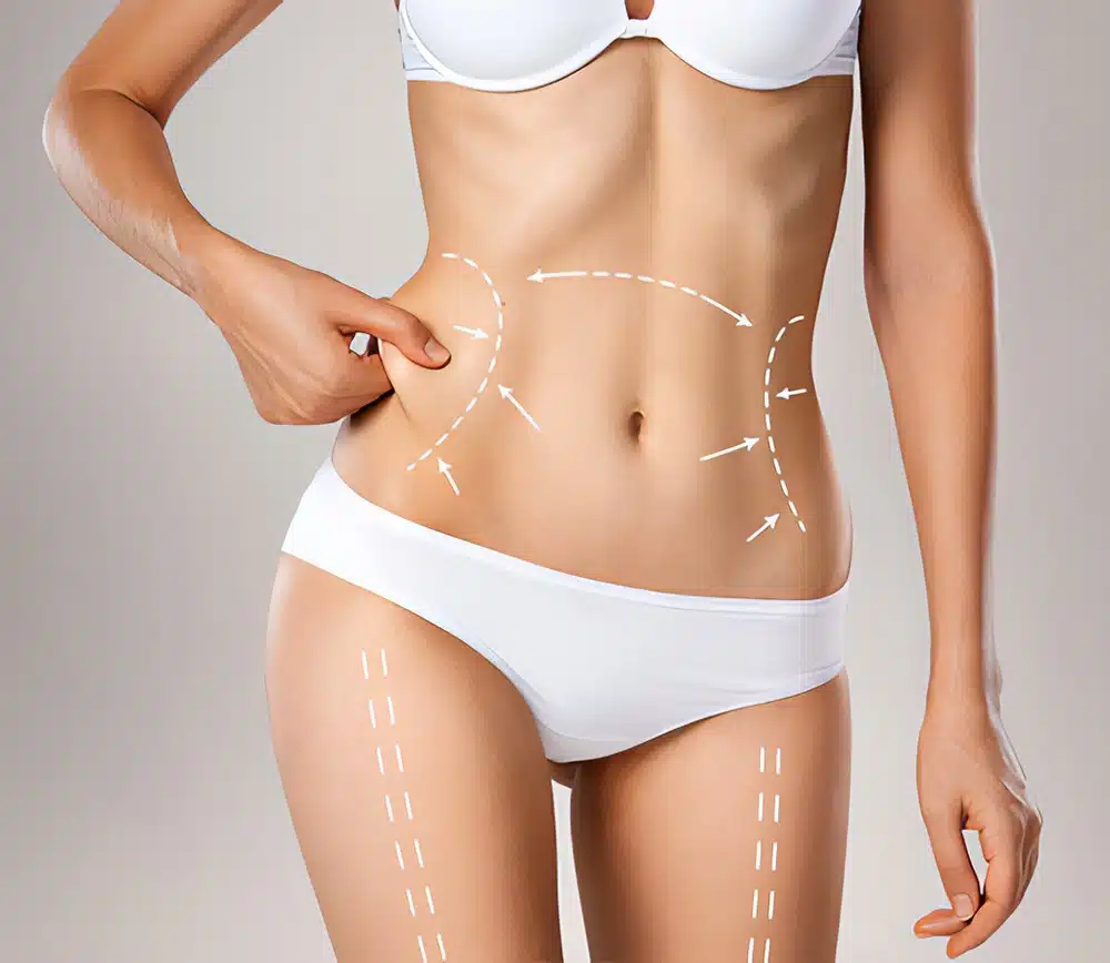 How long it takes to recover from liposuction