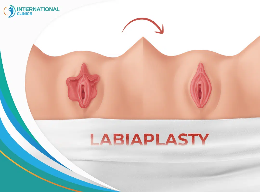 Labiaplasty Recovery Testimonials: Real Experiences & Reviews