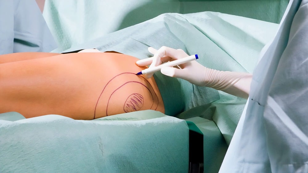 Liposuction methods