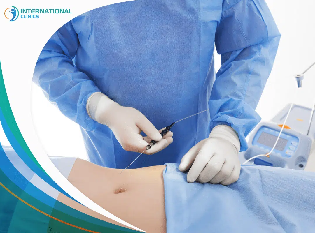 Laser Liposuction: How It Works & What to Expect