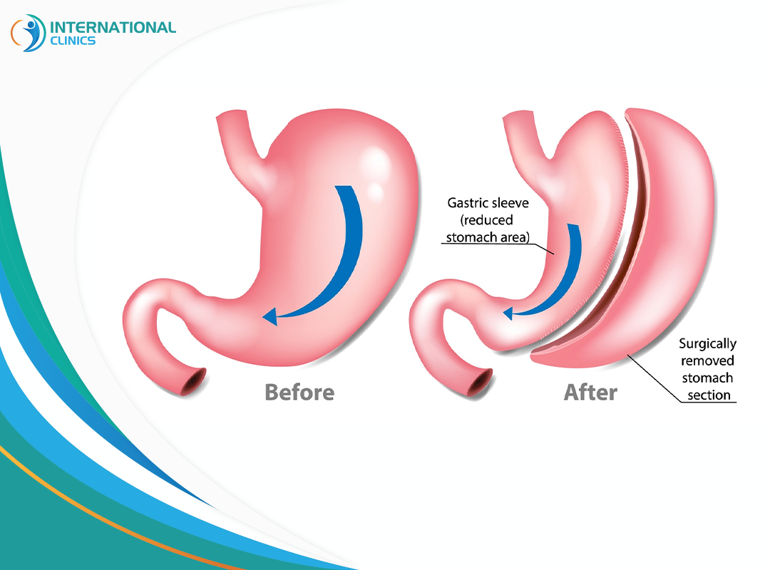 What’s Gastric Sleeve Surgery? A Comprehensive Guide