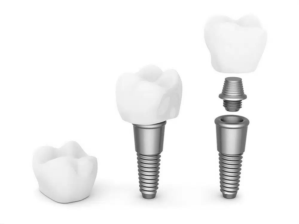 2d655b81408ff9e22a29a41054b5ba73 Dental Implants in Turkey