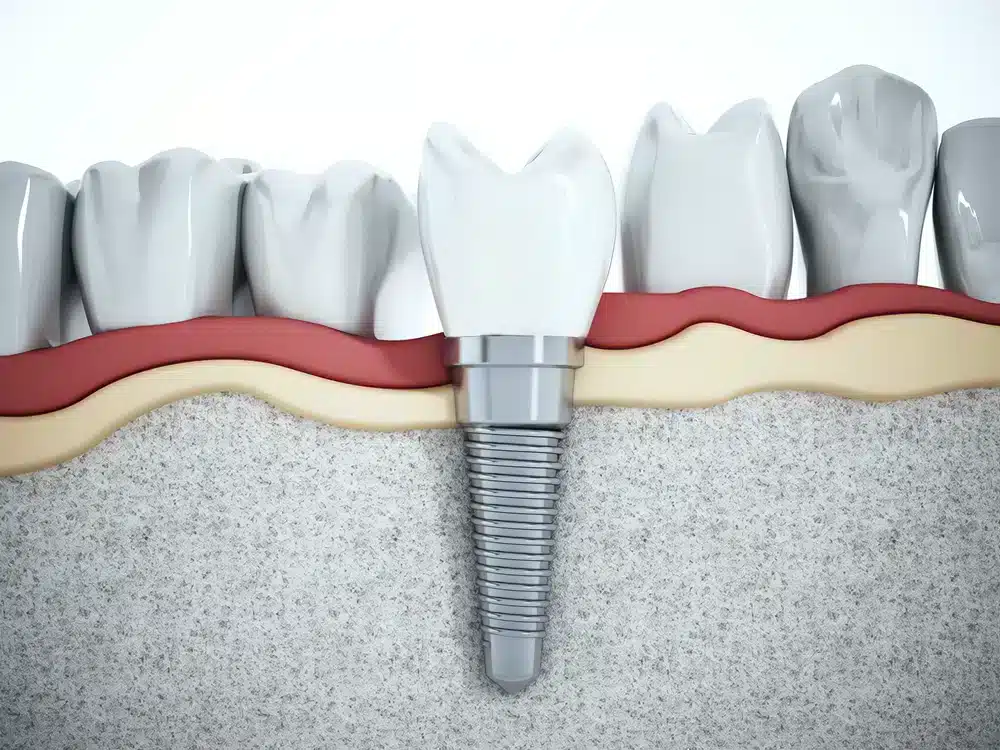 7d5546253c31c911a83d2881cb19b229 Dental Implants in Turkey