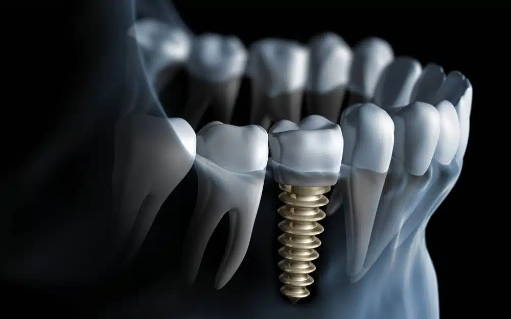 81c94555f6c8fe16fa38faa15a588d07 Dental Implants in Turkey