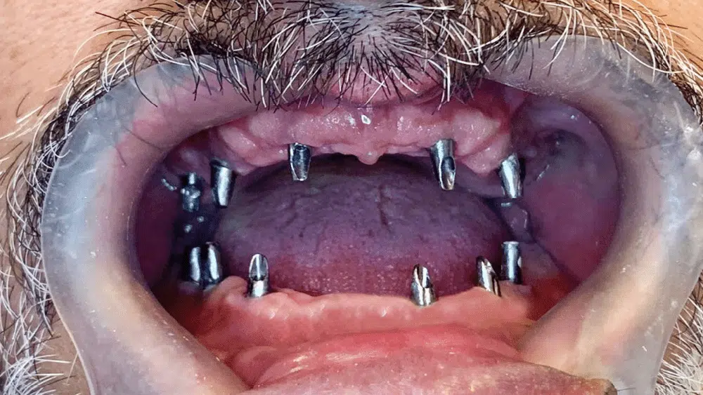 a7f77fbf92b75fa1381d318c77b128af Dental Implants in Turkey