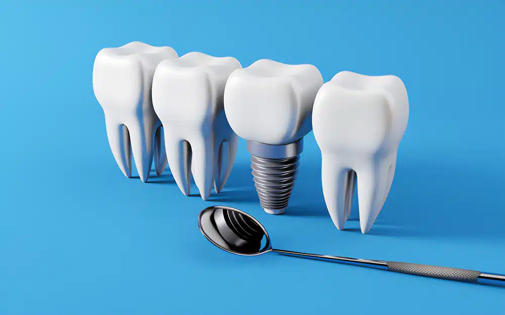 Costo de implantes dentales en Turquía
