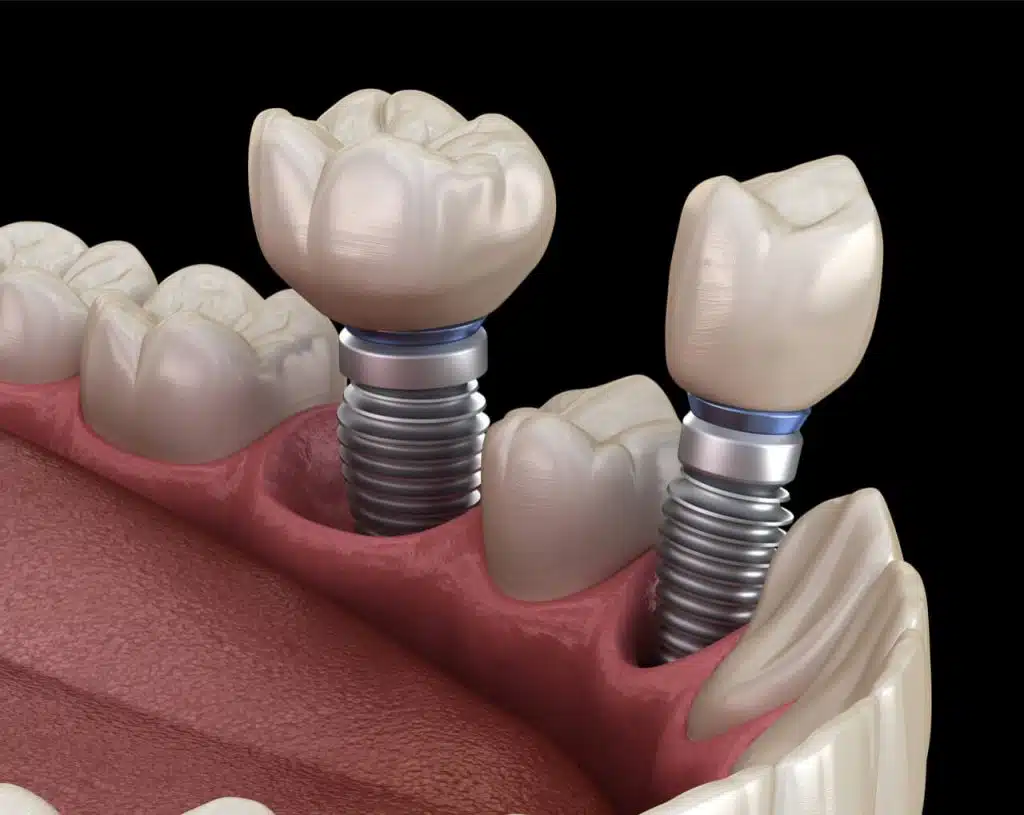 af6f19f639ec2066404a0b32e9c1507b Dental Implants in Turkey