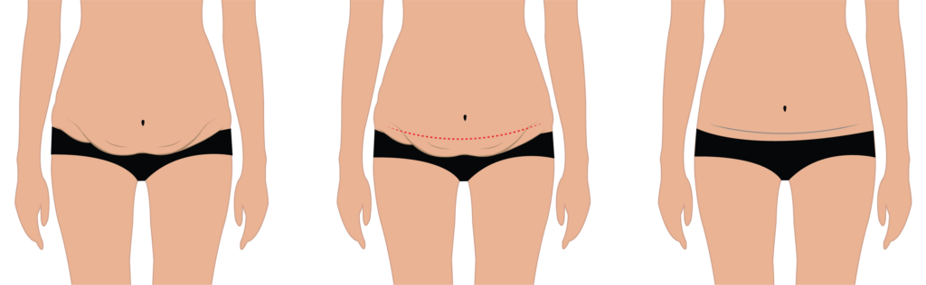 Recovery and Aftercare Following Abdominoplasty