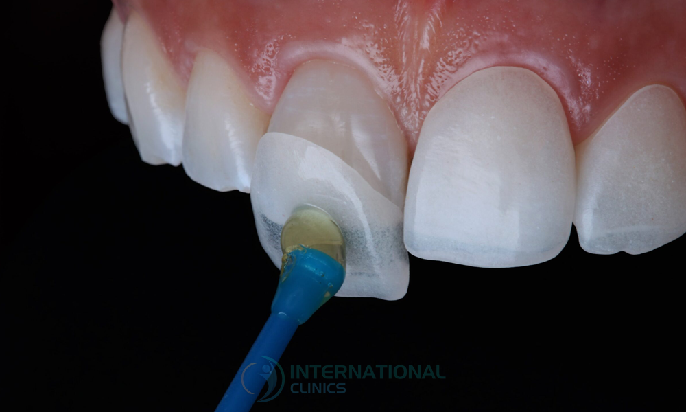 بدائل ابتسامة هوليوود