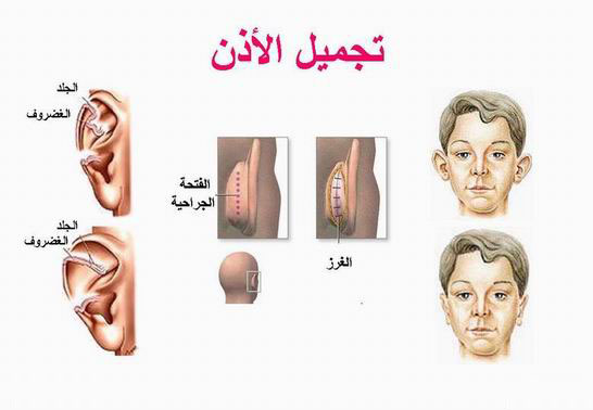 جراحة تجميل الأذن في تركيا