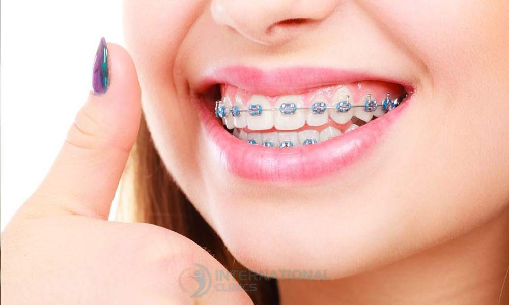 بدائل ابتسامة هوليوود