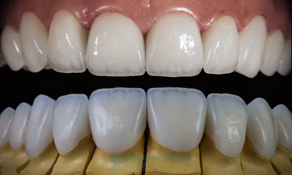 بدائل ابتسامة هوليوود