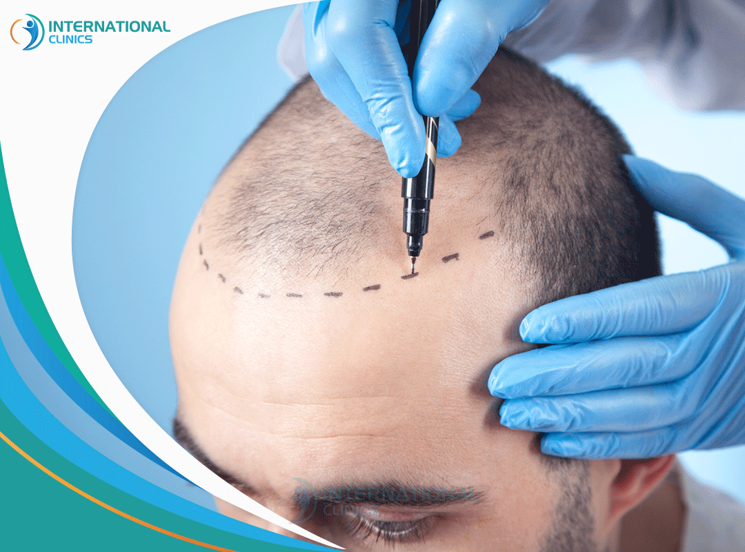 Understanding Hair Transplant Techniques: A Detailed Guide 2024 ...