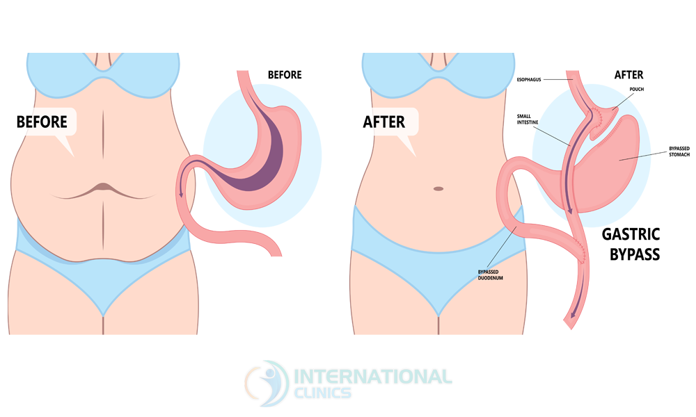 5126e0fd446528a74662c6a9c839894e Gastric Bypass Surgery Cost in Turkey,Gastric Bypass Cost in Turkey
