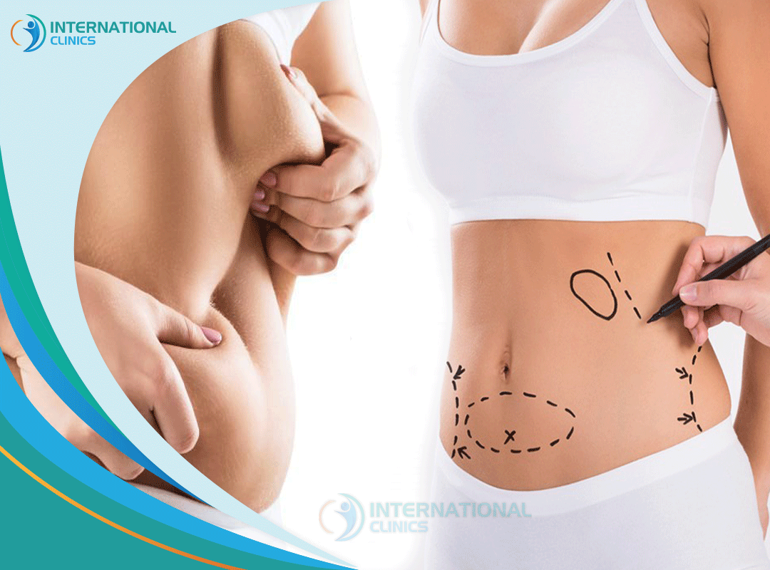 Abdominoplasty Uncovered: A Detailed Look into Tummy Tuck Surgery