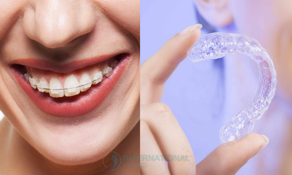 بدائل ابتسامة هوليوود