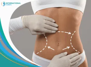 7058b58a835590c667760133ade3b5cb different types of liposuction,types of liposuction