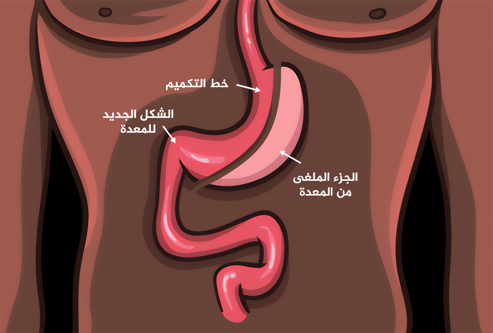 كيفية عملية تكميم المعدة