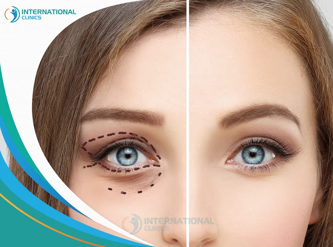 Eyelid Surgery: The Ultimate Guide to Blepharoplasty Plastic Surgery