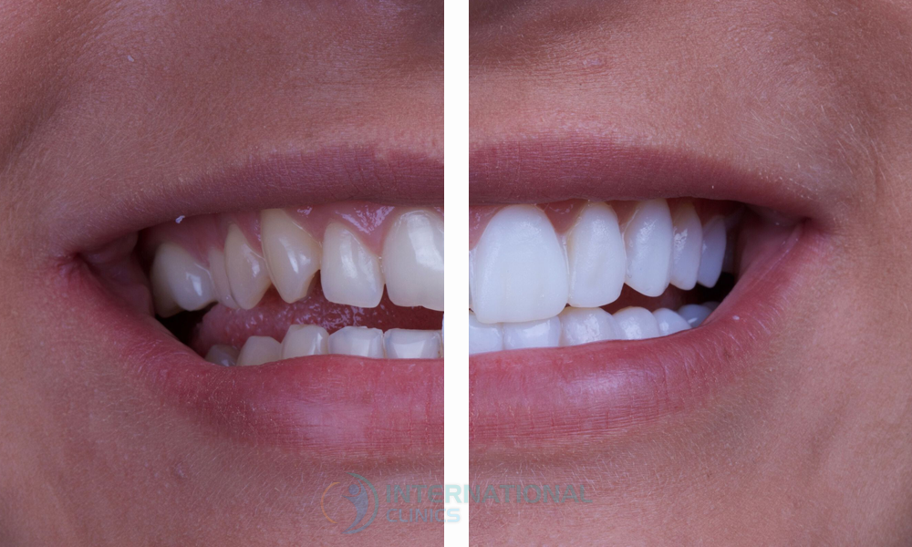 بدائل ابتسامة هوليوود