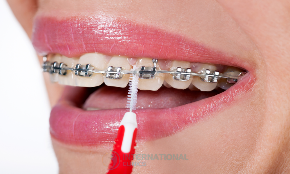 بدائل ابتسامة هوليوود