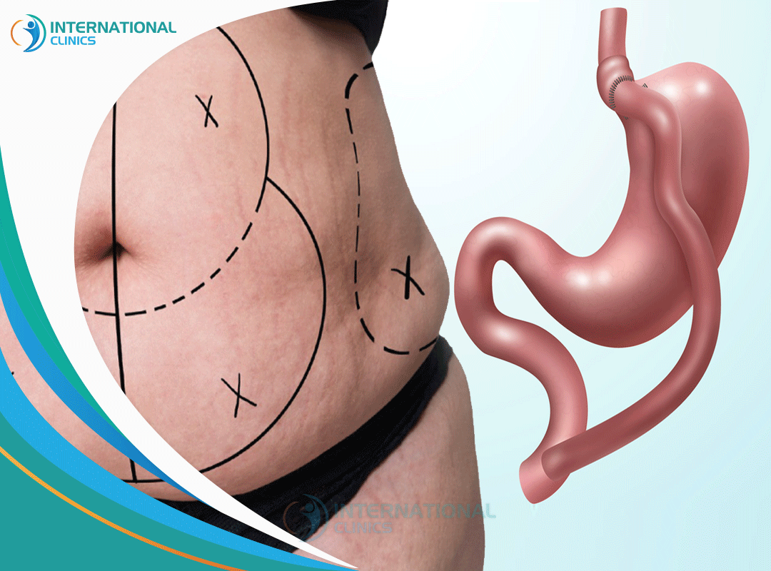 Gastric Sleeve Recovery Time: What to Expect?