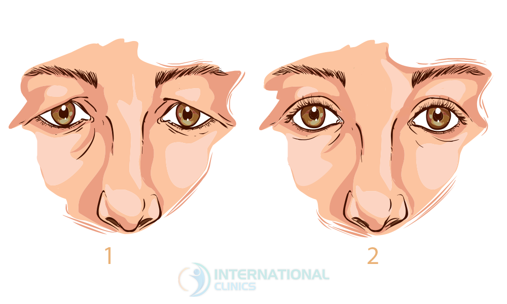 Outcomes of Blepharoplasty Surgery